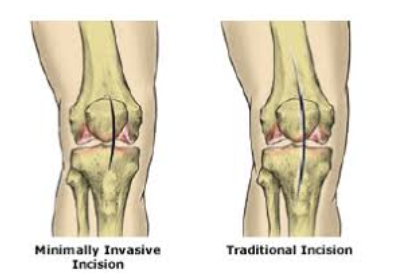 Mini-Invasive Orthopedic Surgery Treatment in Pune