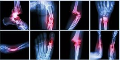 What Constitutes Orthopedic Trauma  Orthopaedic Associates