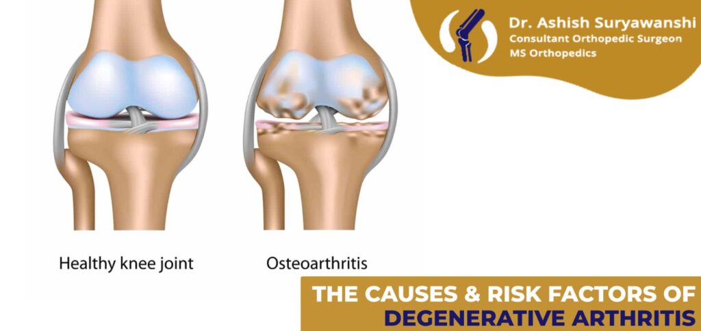 Dr. Ashish Suryawanshi, your trusted orthopedic expert in Pune.