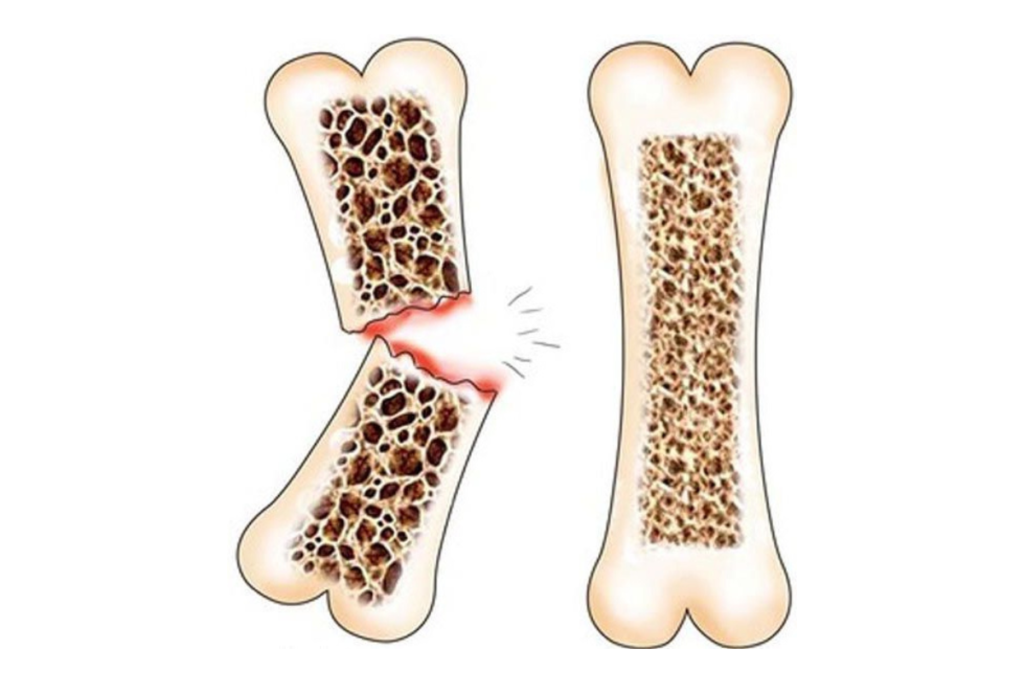 Strategies for Osteoporosis Prevention and Fall Awareness