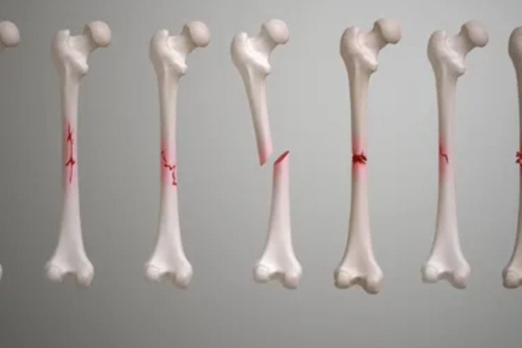 Types of bone fractures and their treatments in Pune