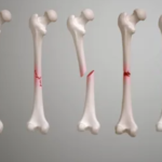 Types of bone fractures and their treatments in Pune