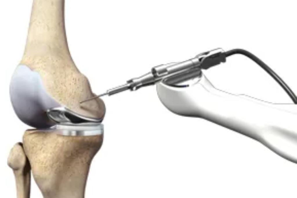 Knee Replacement Services by Dr. Ashish Suryawanshi, Orthopedic in Pune.