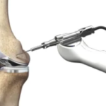 Knee Replacement Services by Dr. Ashish Suryawanshi, Orthopedic in Pune.