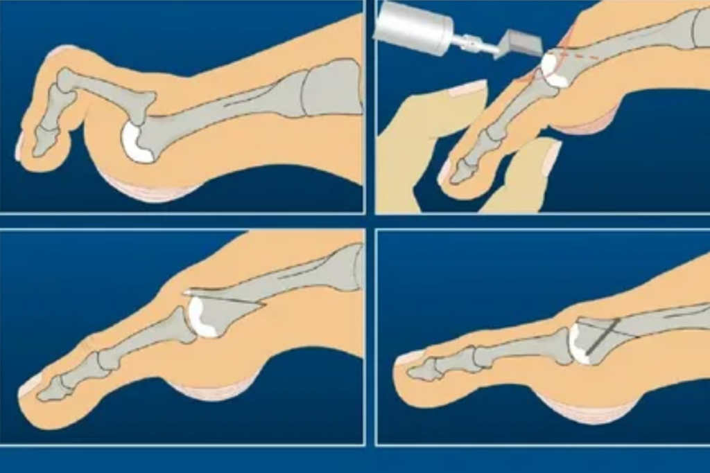 A surgical procedure to reshape or reposition bones