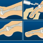 A surgical procedure to reshape or reposition bones